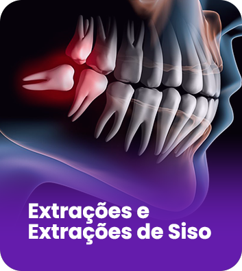 EXTRAÇÕES-DE-SISO