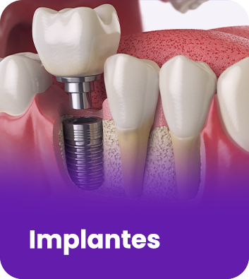 IMPLANTES